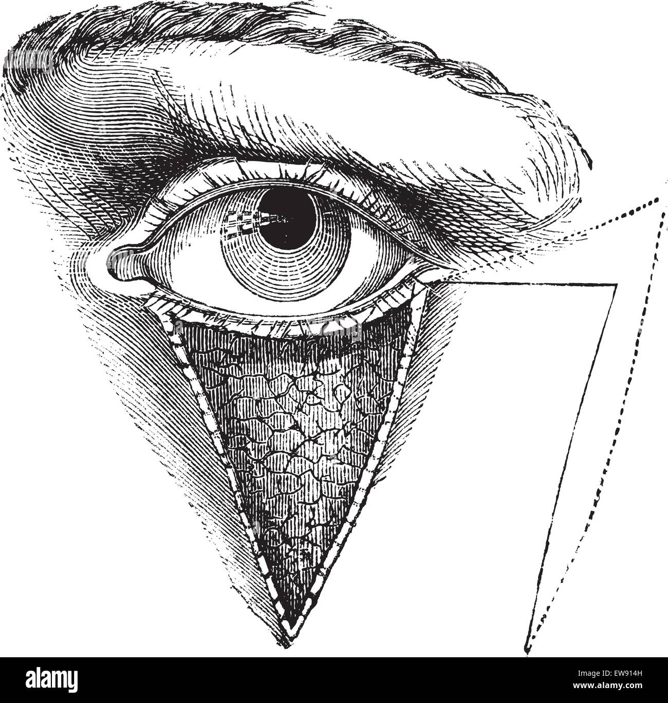 Fig. 179. Della blefaroplastica mediante il metodo di Dieffembach, vintage illustrazioni incise. Al solito Dizionario medicina - Paolo Labarthe Illustrazione Vettoriale