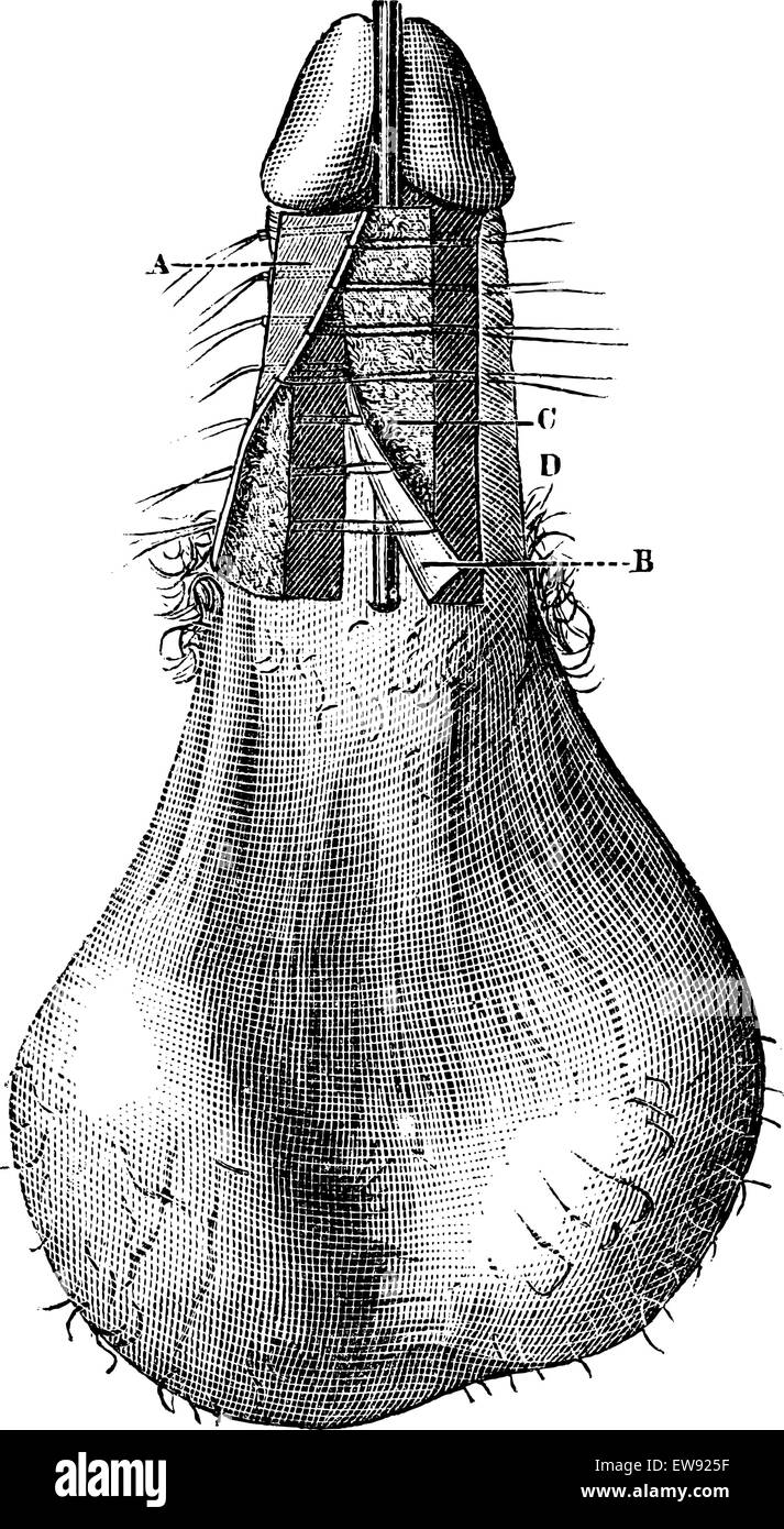 Funzionamento di ipospadia (processo per Th ira), vintage illustrazioni incise. Magasin pittoresco 1875. Illustrazione Vettoriale