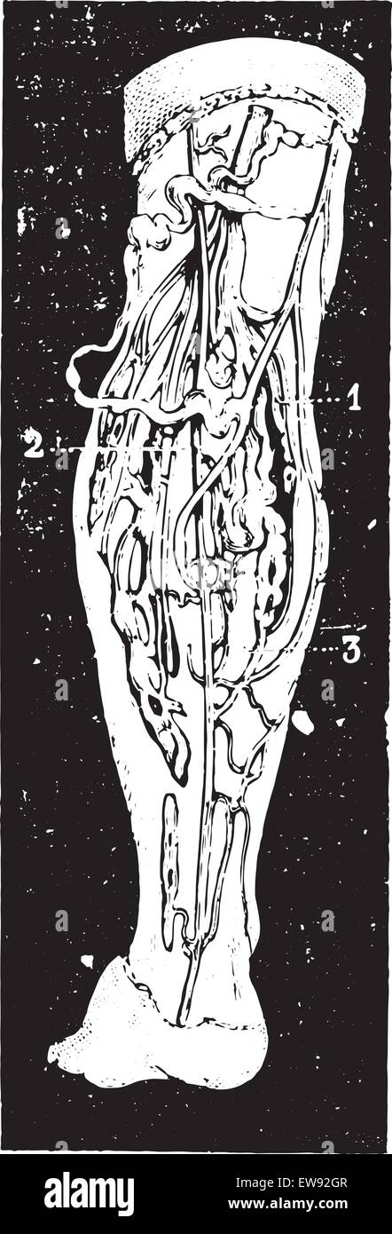 Vene varicose della gamba, vintage illustrazioni incise. Al solito Dizionario medicina dal dr. Labarthe - 1885. Illustrazione Vettoriale