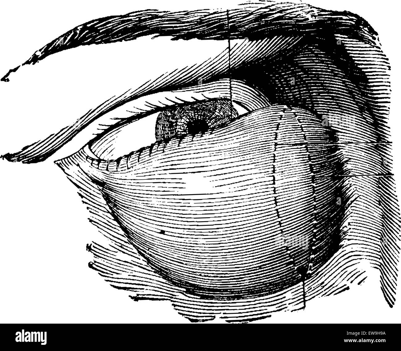 Altamente sviluppato tumore lacrimale, vintage illustrazioni incise. Al solito Dizionario medicina dal dr. Labarthe - 1885 Illustrazione Vettoriale