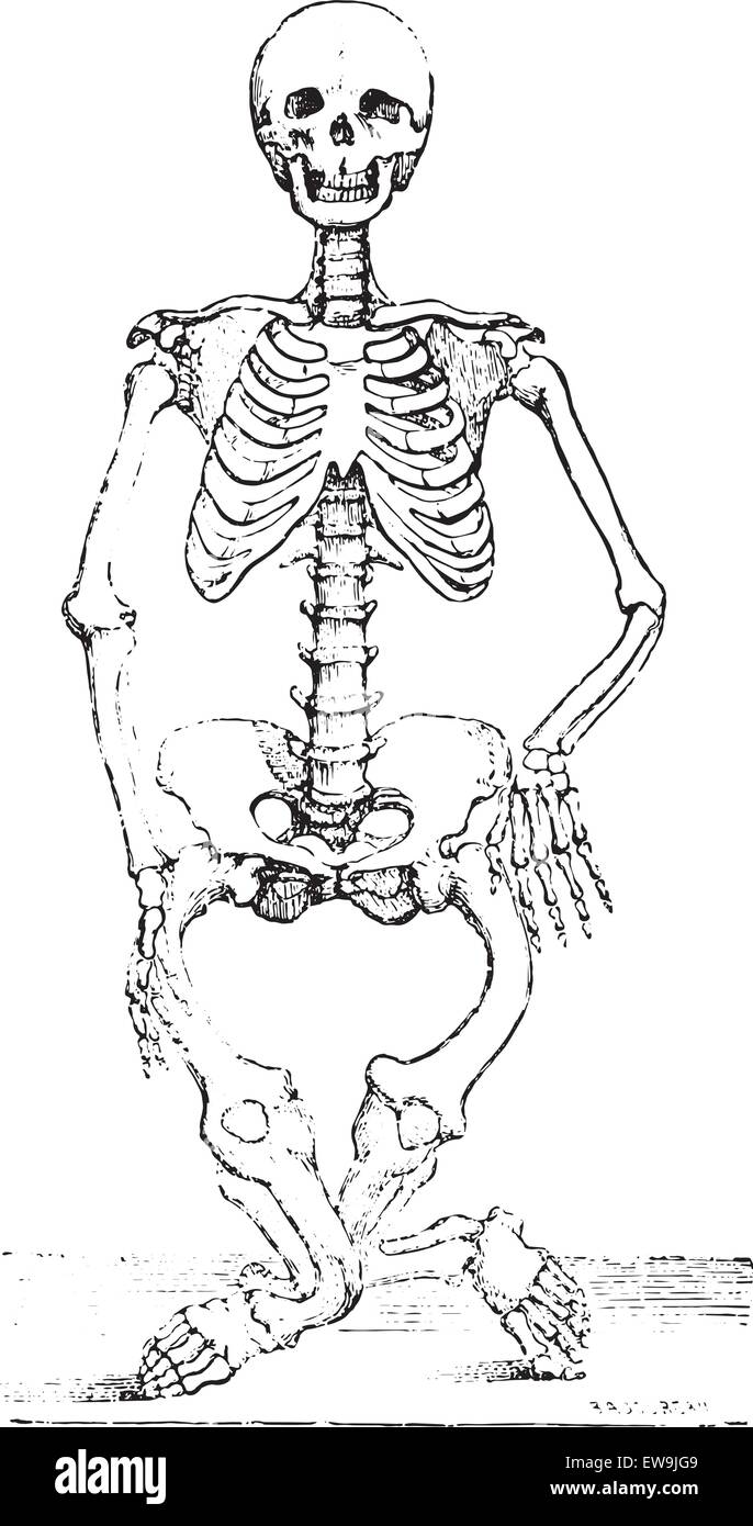Lo scheletro deformato da rachitismo, vintage illustrazioni incise. Al solito Dizionario medicina dal dr. Labarthe - 1885. Illustrazione Vettoriale
