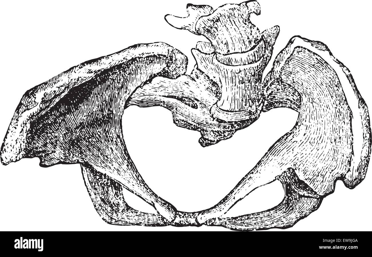 Bacino deformato da rachitismo, vintage illustrazioni incise. Al solito Dizionario medicina dal dr. Labarthe - 1885. Illustrazione Vettoriale