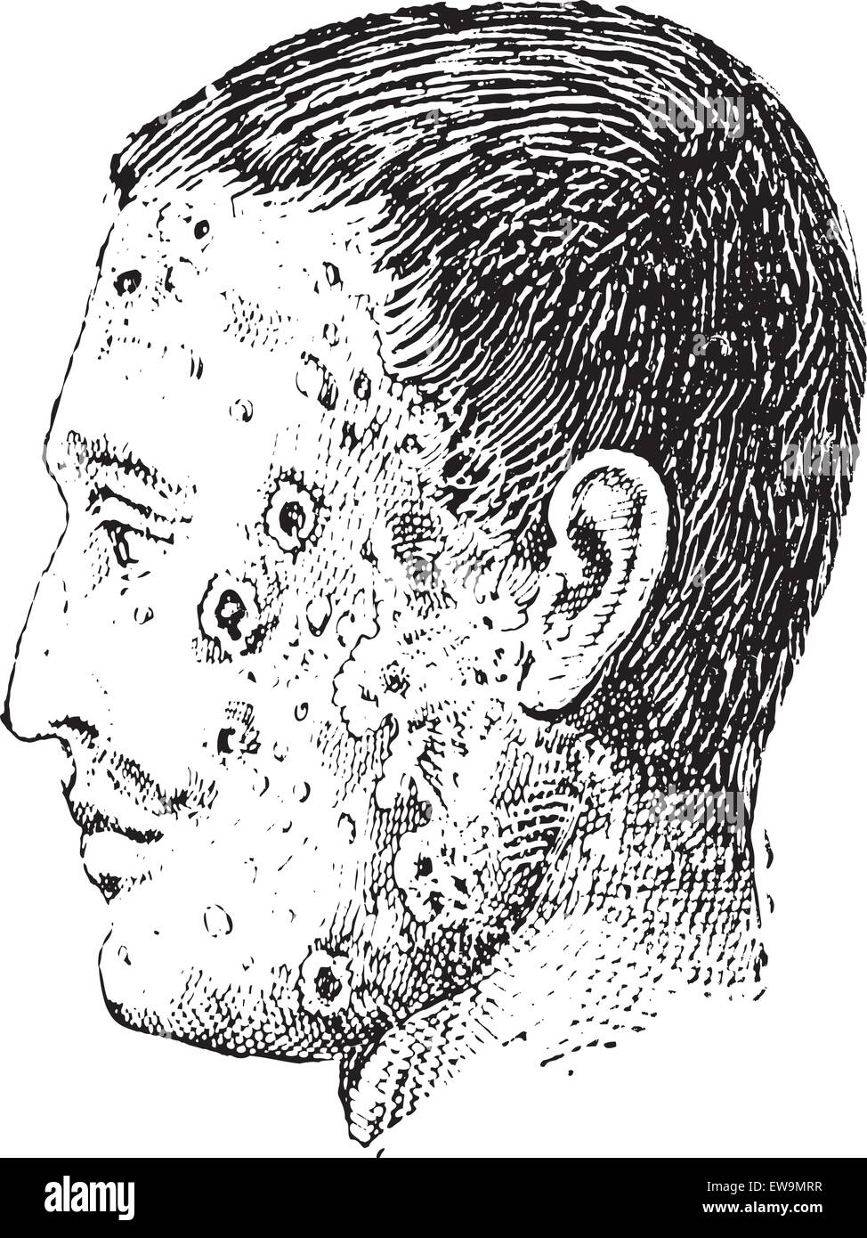 Vecchie illustrazioni incise di volto umano infettata con impetigo isolato su uno sfondo bianco. Dizionario di parole e le cose - Illustrazione Vettoriale