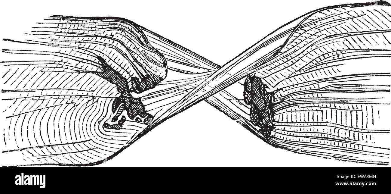Strappata fibra muscolare, vintage illustrazioni incise. Trousset enciclopedia (1886 - 1891). Illustrazione Vettoriale