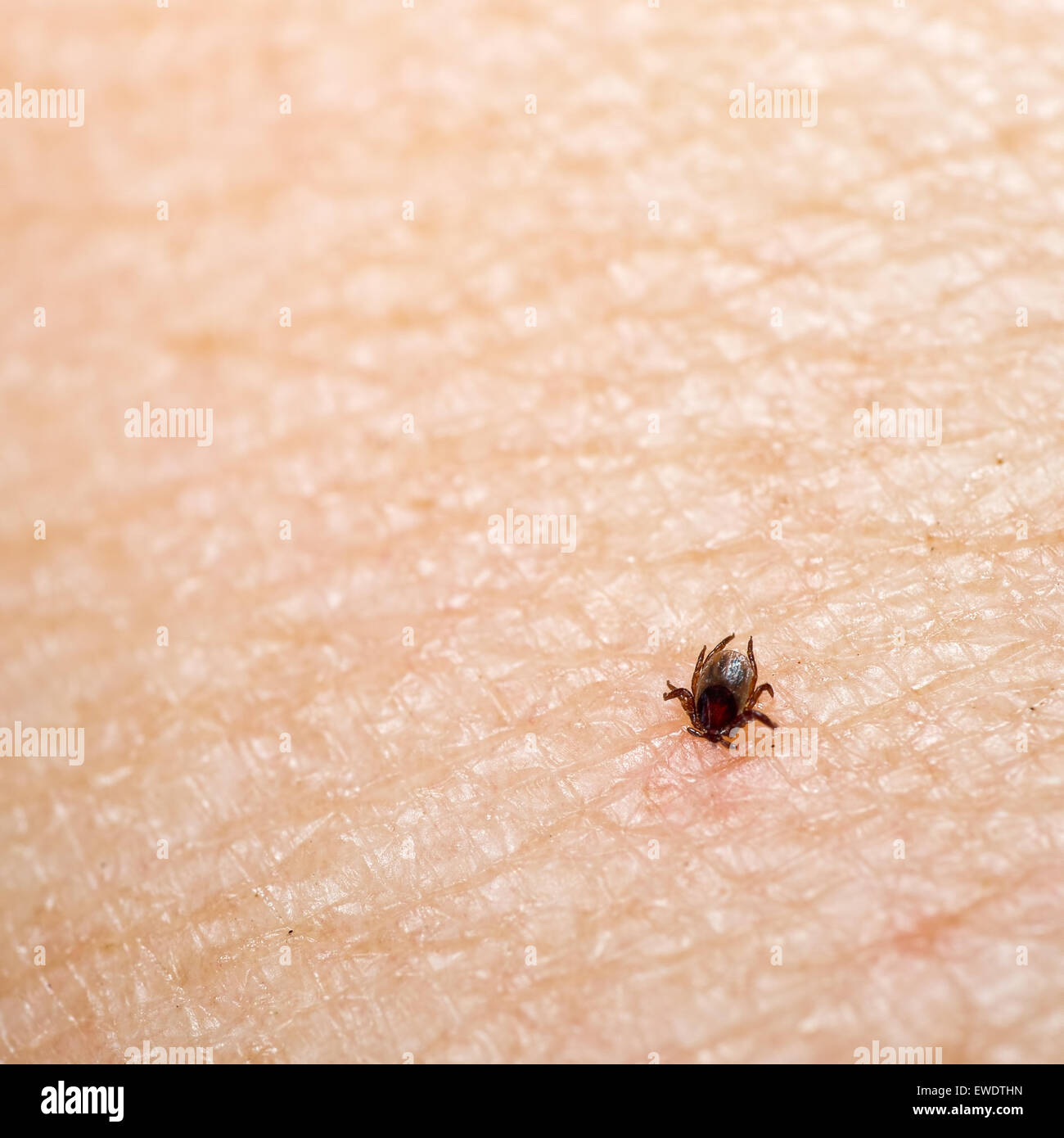 Piccolo insetto tick con testa sepolto nella pelle umana. Rischio di malattia. Foto Stock