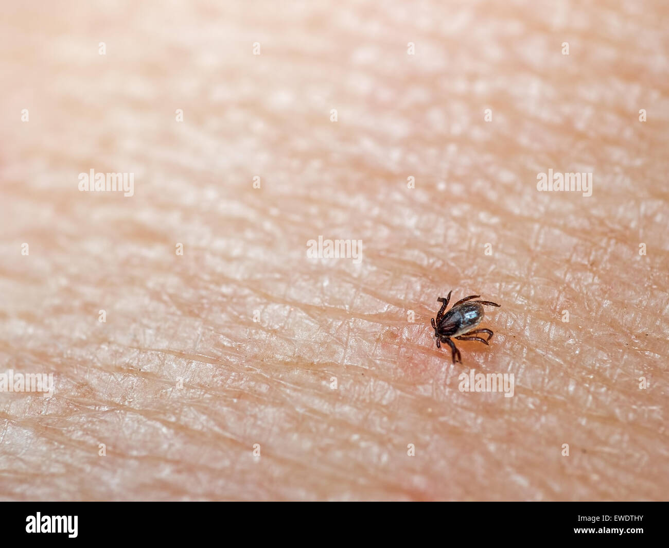 Piccolo insetto tick con testa sepolto nella pelle umana. Rischio di malattia. Foto Stock