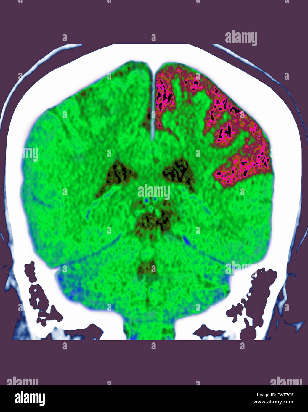 Atrofia cerebrale, TC-SCAN Foto Stock