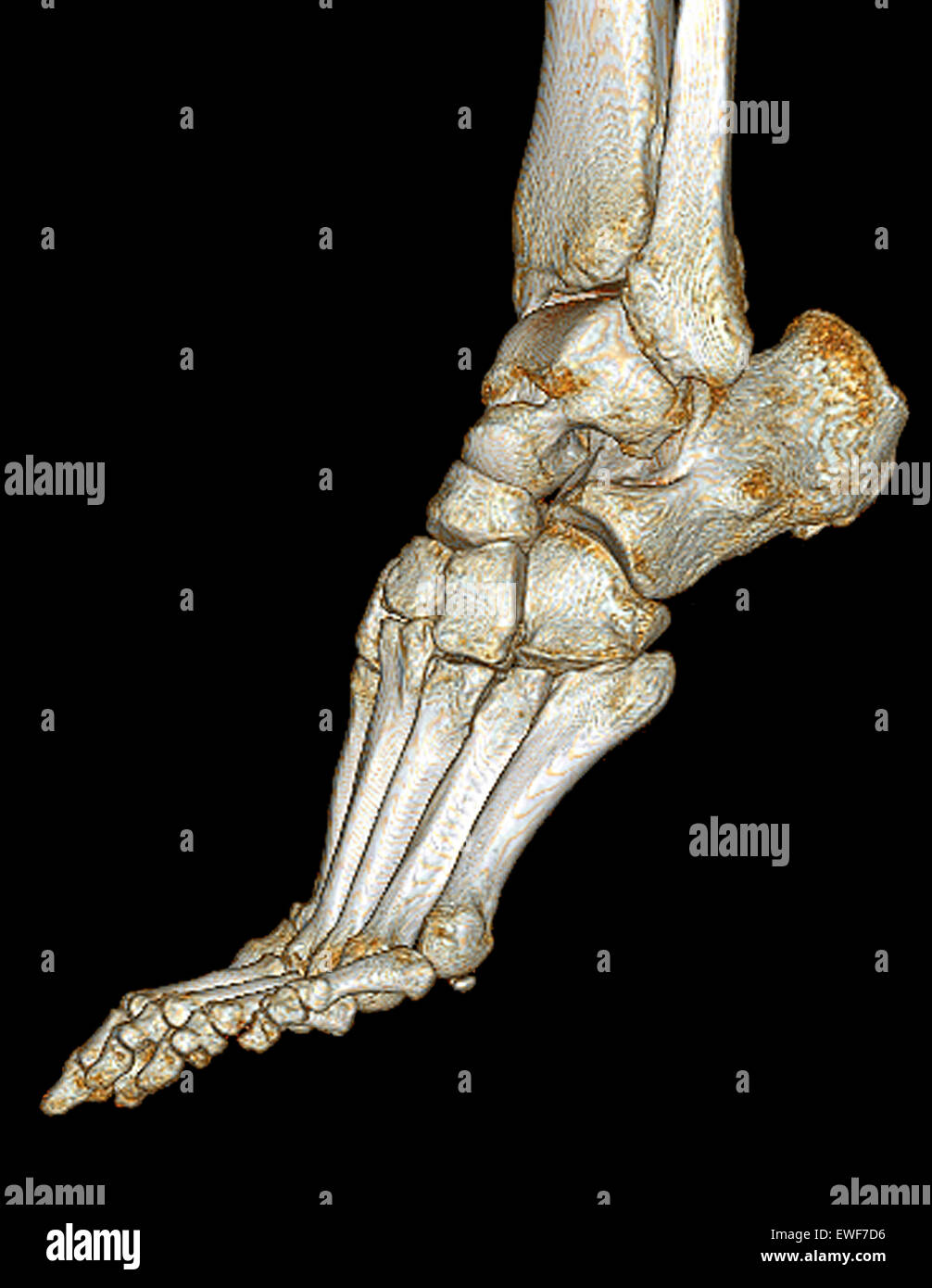 PIEDE, CT-SCAN Foto Stock