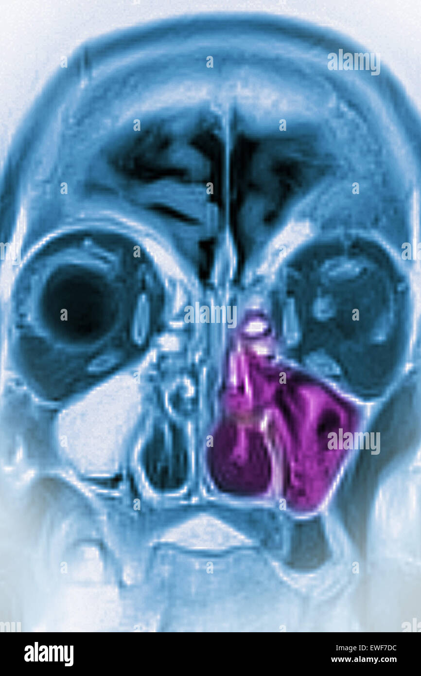 MRI DI SINUSITE Foto Stock