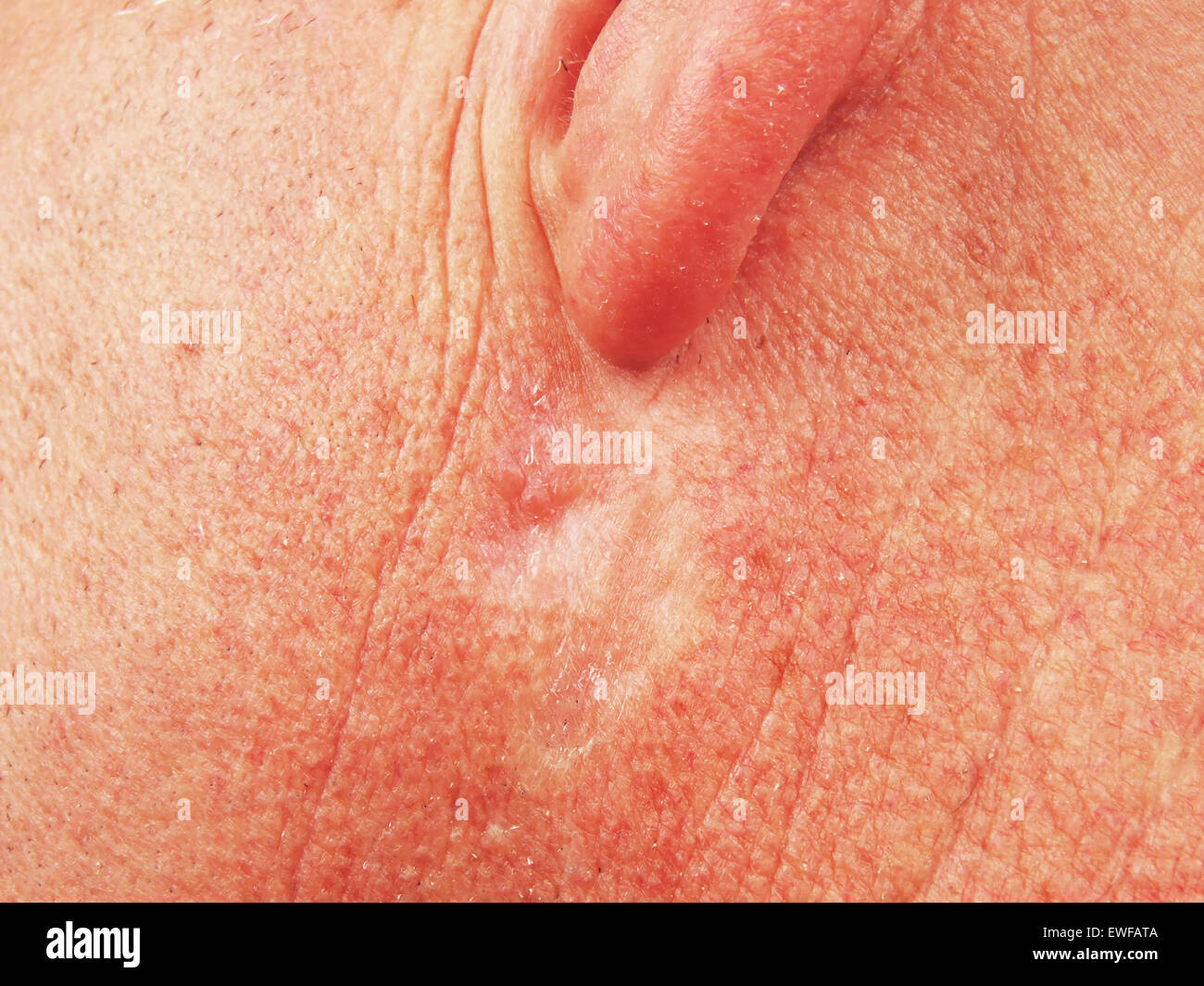 Il carcinoma a cellule basali Foto Stock