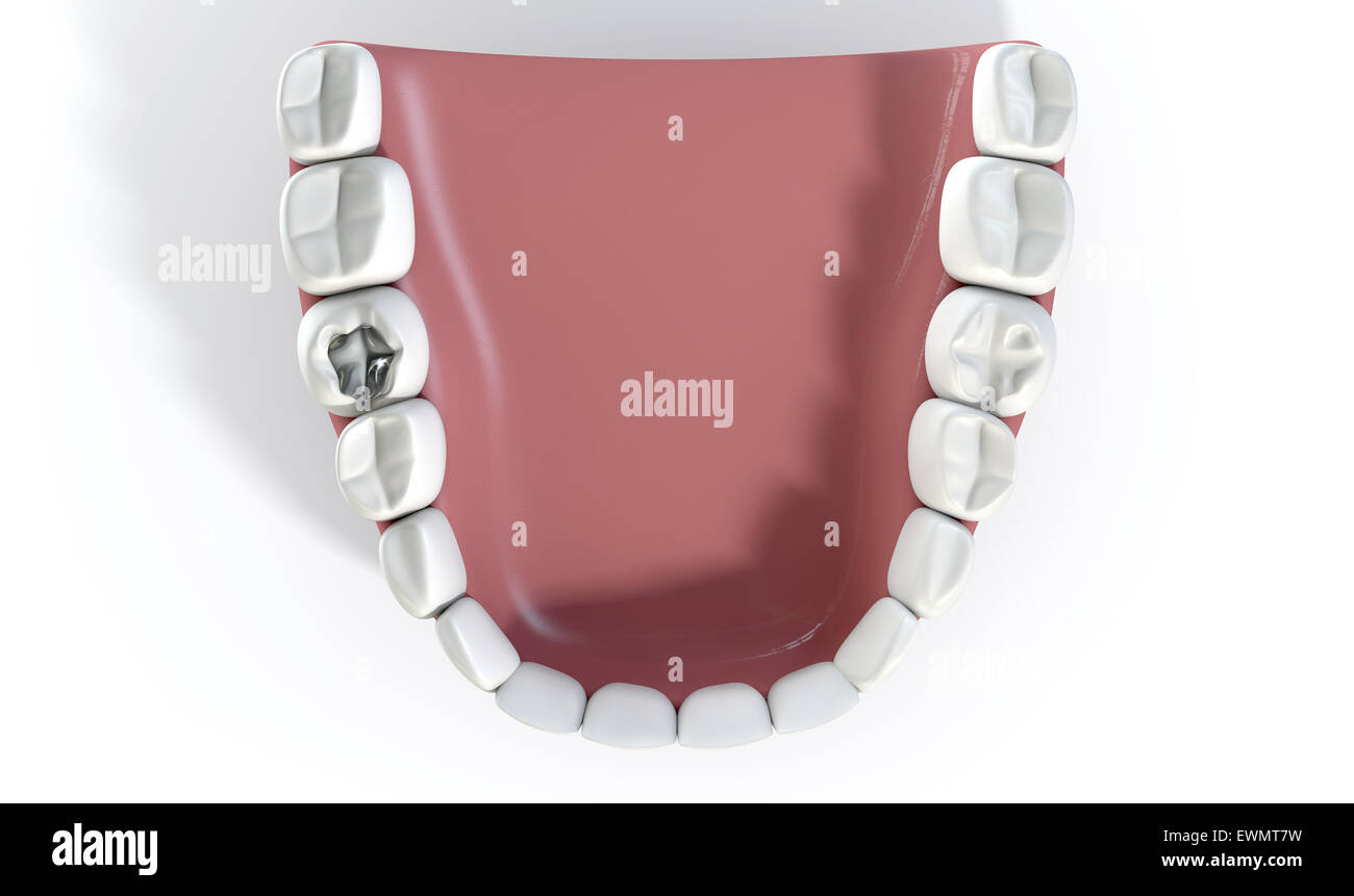 Un filo di riempimento della cavità su un molare in un set di falsi denti umani impostato in con gomme isolato su un background Foto Stock