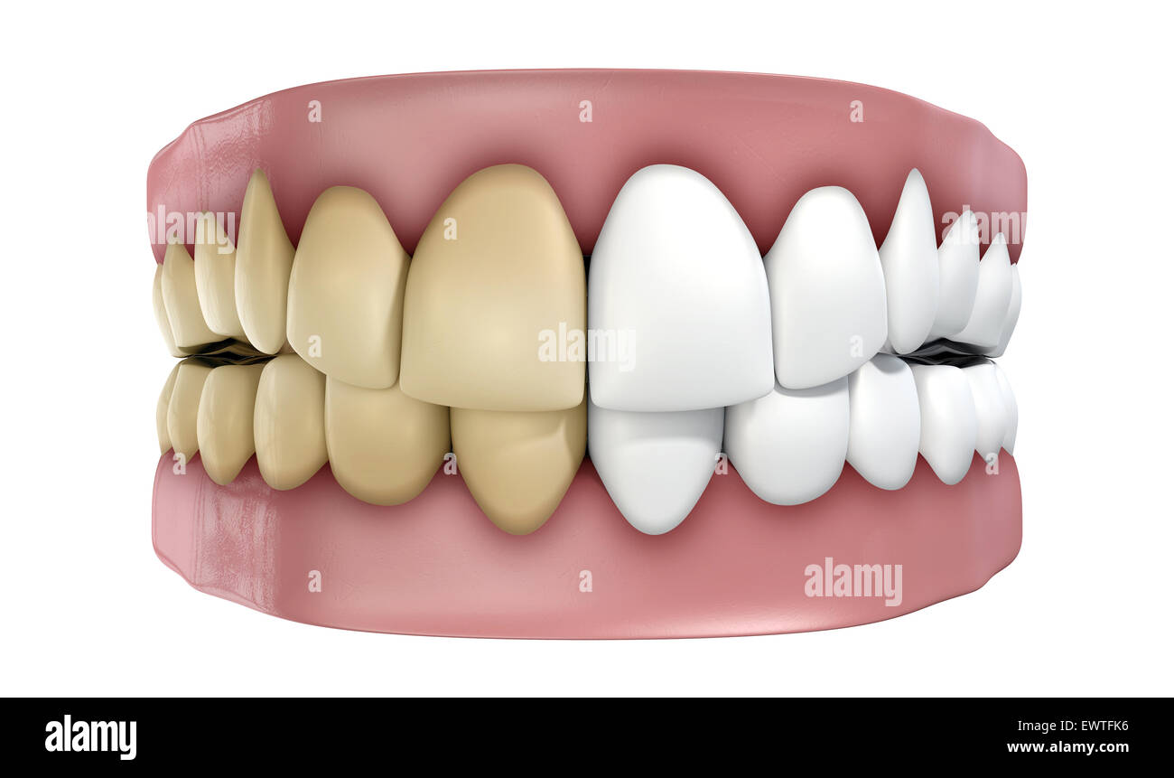 Una serie di denti finti con mezzo pulito e bianco e l'altro ingiallito e  colorati su un isolato bianco di sfondo per studio Foto stock - Alamy