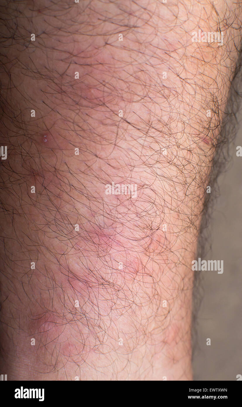 Molti morsi di zanzara sulla gamba di un maschio caucasico Foto Stock