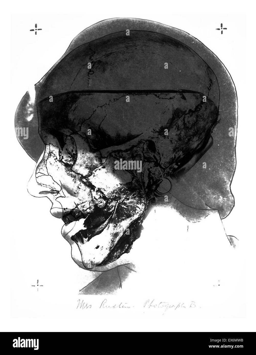 Cranio n. 2, fotografia B, 1935. Gli investigatori fotografato il cranio n. 2 nello stesso orientamento come una fotografia della signora Ruxton. Poi hanno stabilito un foto-la trasparenza di questo cranio sopra il ritratto di stabilire che il cranio è stata la Signora Ruxton's Foto Stock