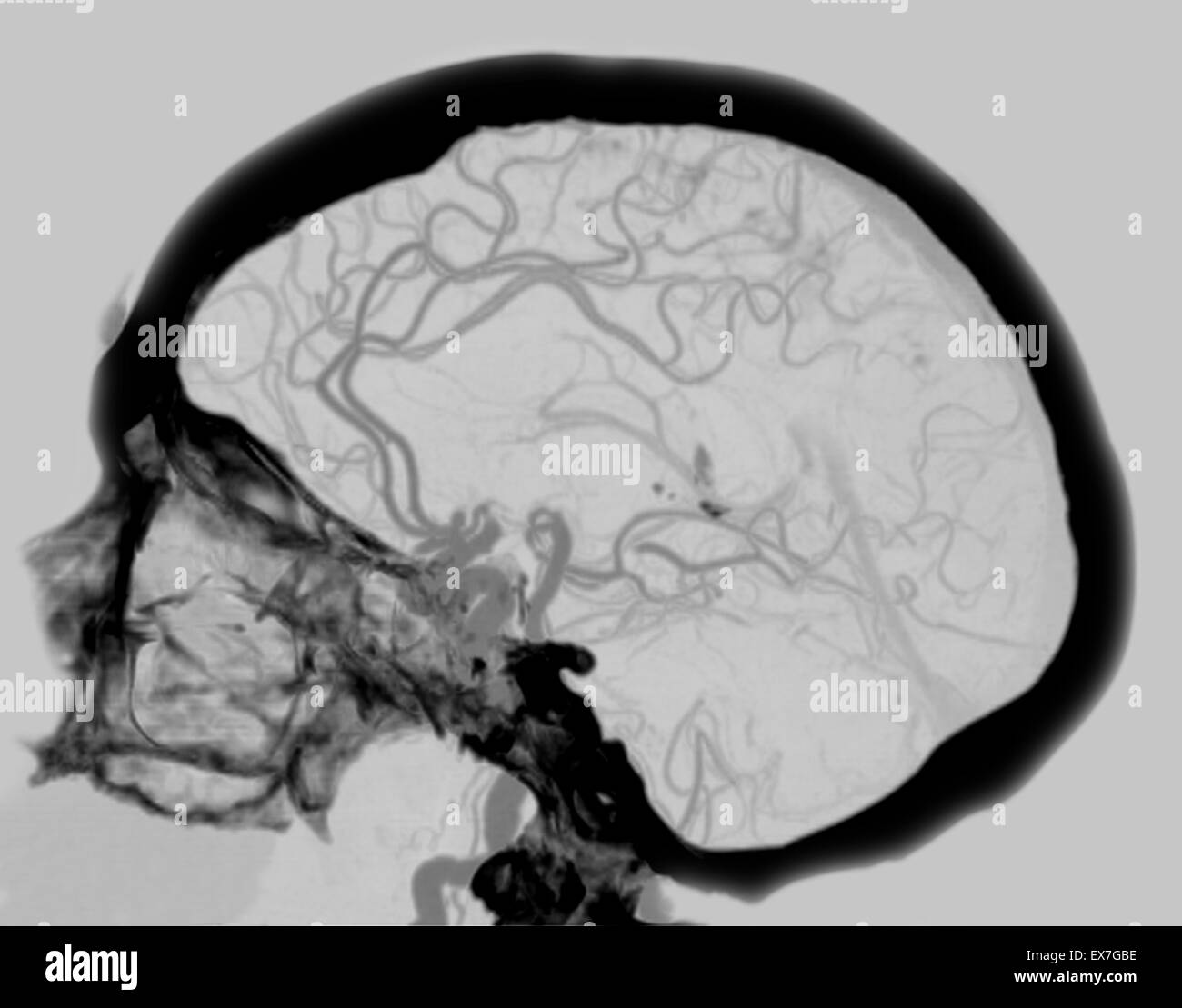 Angiogramma CT che mostra la fornitura sanguigna del cervello, compreso il circolo di Willis. Foto Stock