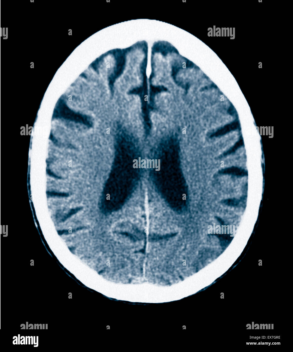 Scansione TC di un 84 anno vecchio con il morbo di Alzheimer. CT mostra atrofia cerebrale. Foto Stock