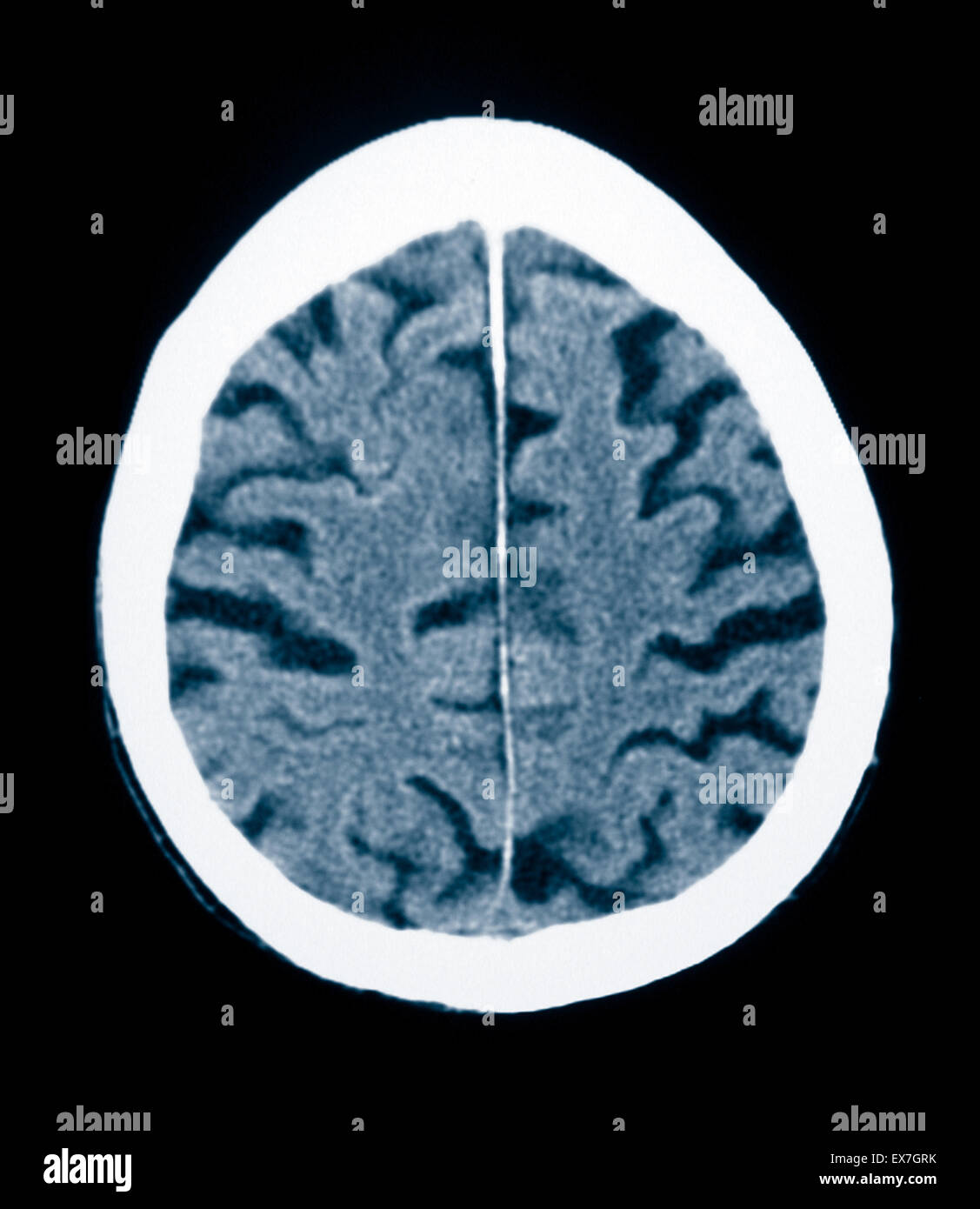 Scansione TC di un 84 anno vecchio con il morbo di Alzheimer. CT mostra atrofia cerebrale. Foto Stock