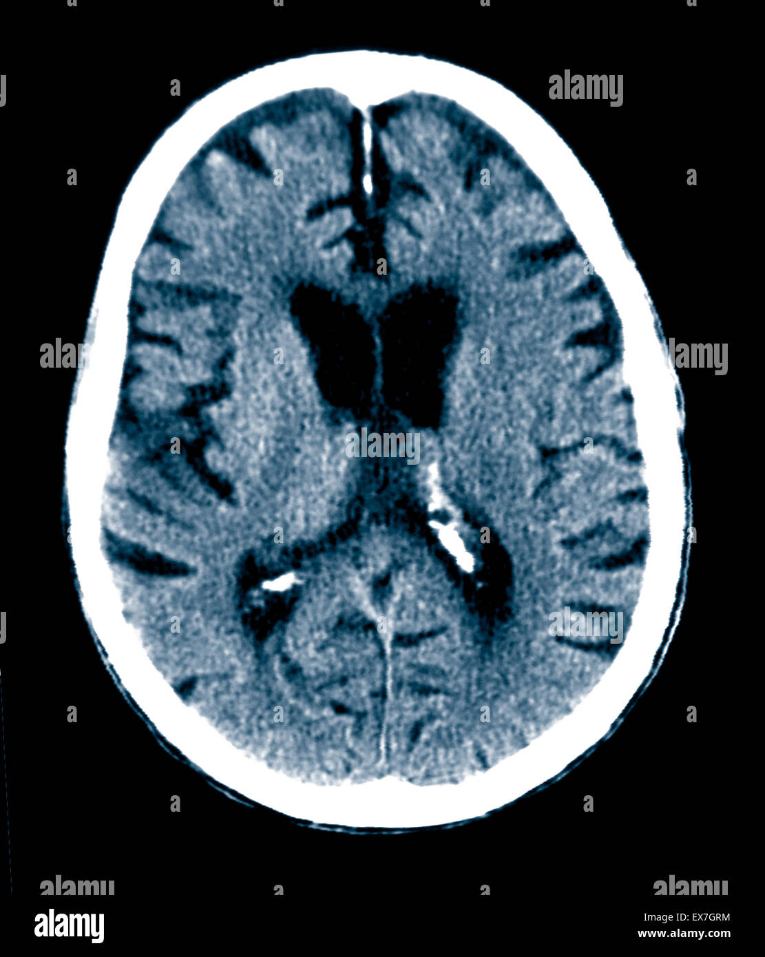 Scansione TC di un 84 anno vecchio con il morbo di Alzheimer. CT mostra atrofia cerebrale. Foto Stock