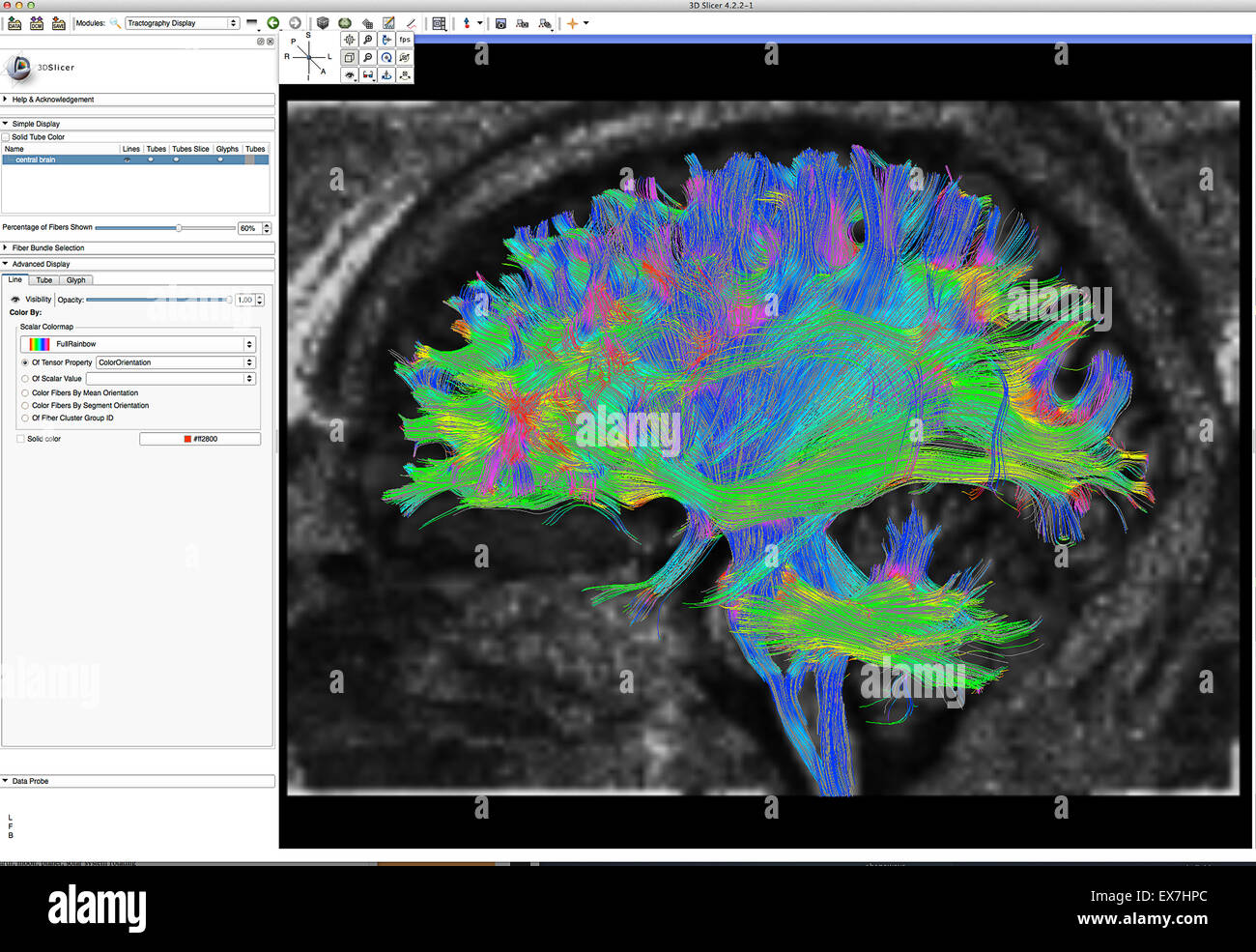 Fibre tractography immagine del cervello umano Foto Stock