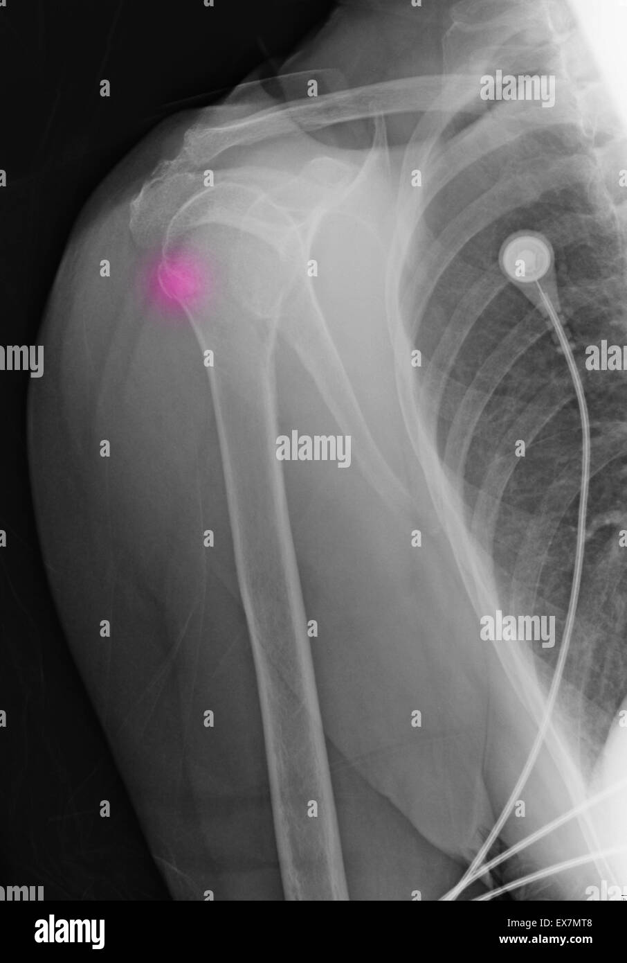 88 enne femmina con Omero superiore la frattura e la storia di osteoporosi Foto Stock