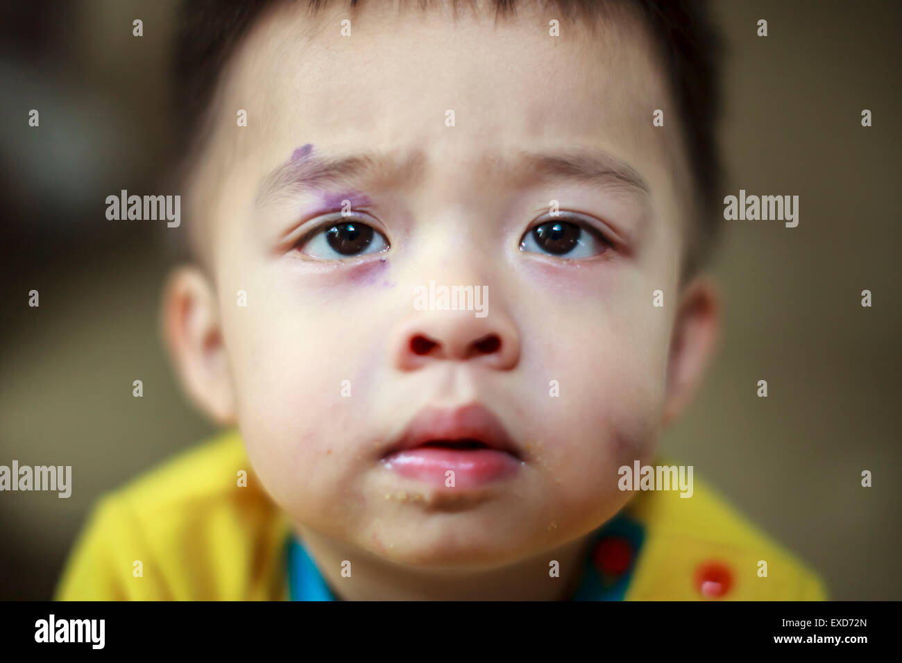 Un bambino con un occhio nero e ammaccature sul suo volto Foto Stock