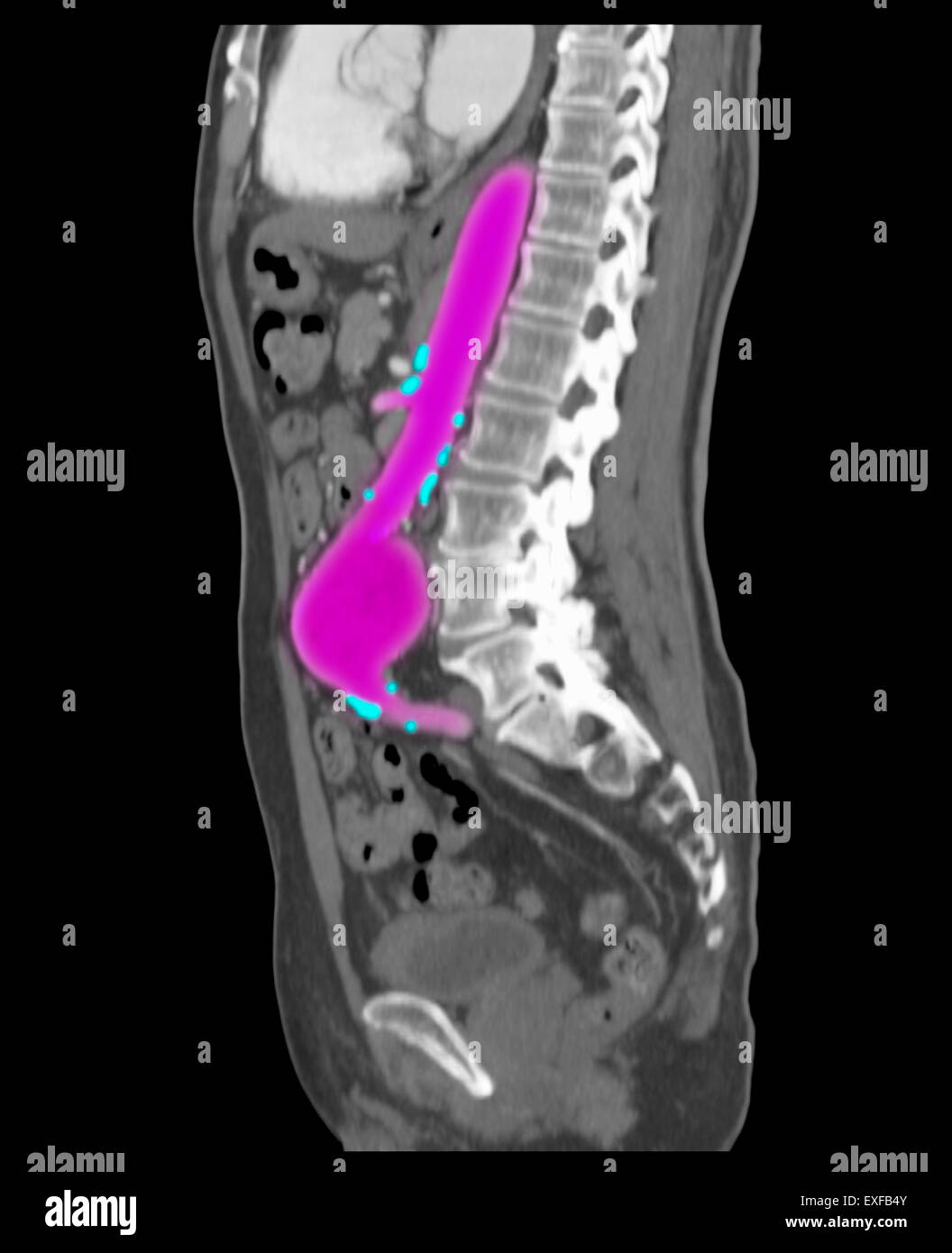 Angiografiche addominale CT scan, aneurisma aortico addominale. Le calcificazioni lungo aorta, rami, arterie aterosclerosi Foto Stock