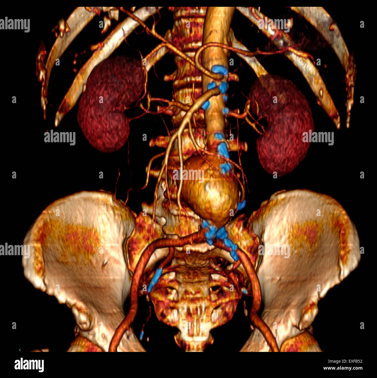 3D angiografiche addominale CT scan, aneurisma aortico addominale. Le calcificazioni lungo aorta, rami, indicando l'aterosclerosi Foto Stock