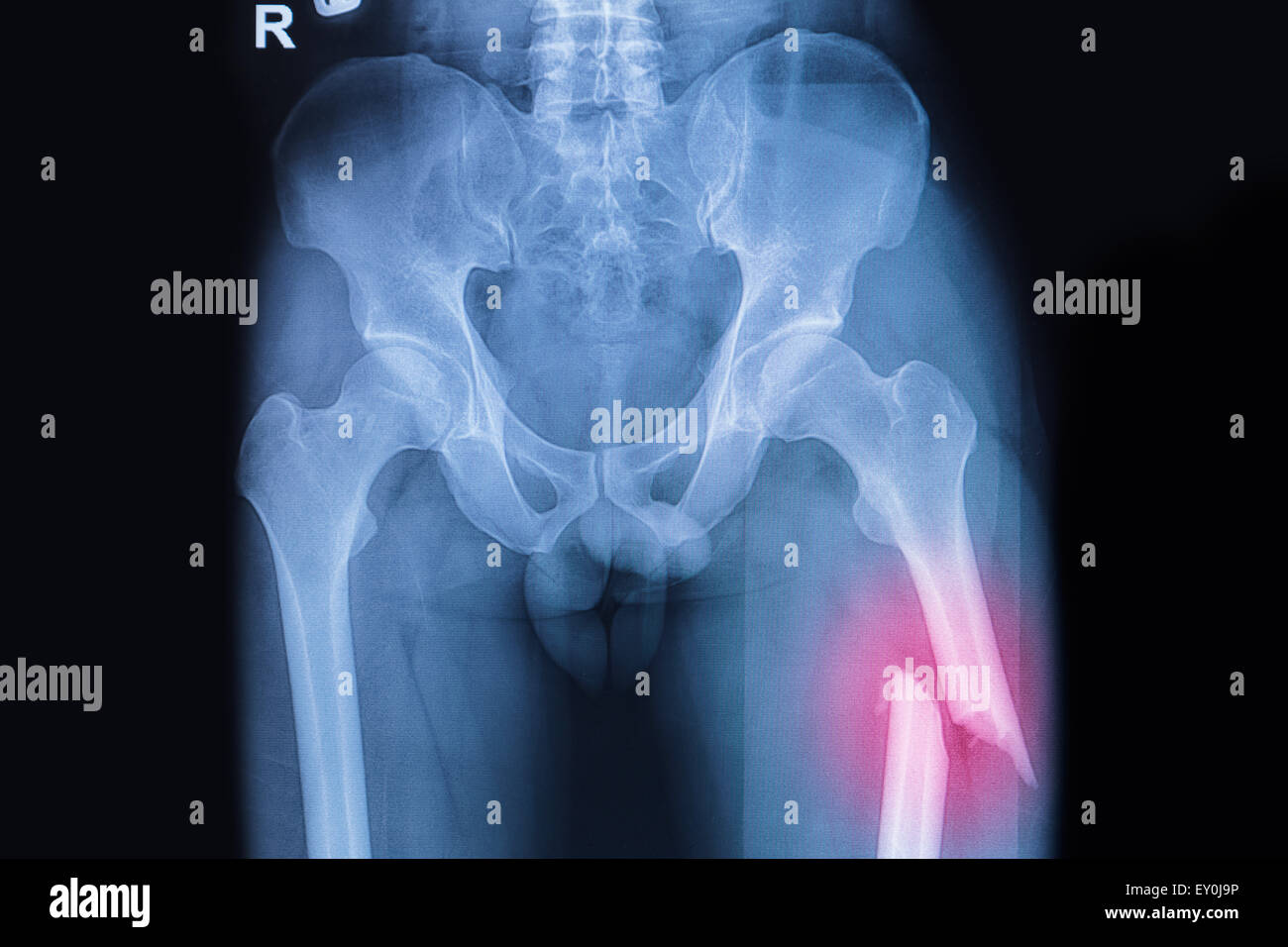 Femore fratturato, rotte coscia raggi x immagine Foto Stock