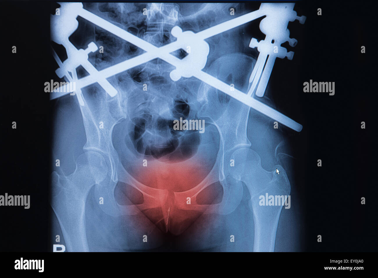 Immagine a raggi x di frattura pubica con fissazione esterna Foto Stock