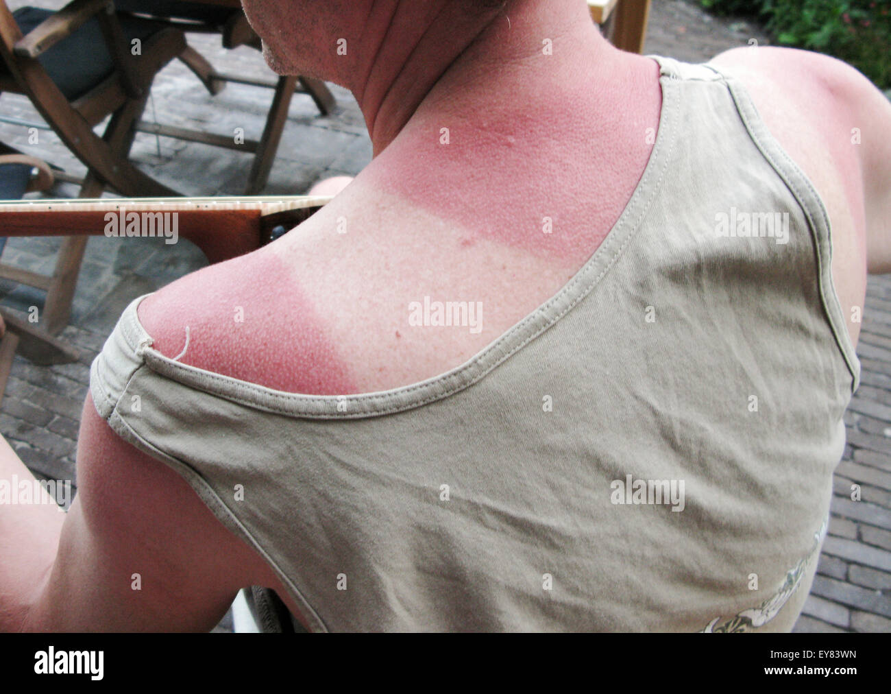 Uomo con spalla bruciata dal sole e retro Foto Stock