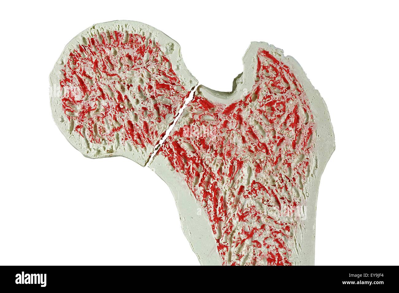 Sezione trasversale attraverso un modello di una frattura del collo del femore (femore). Foto Stock