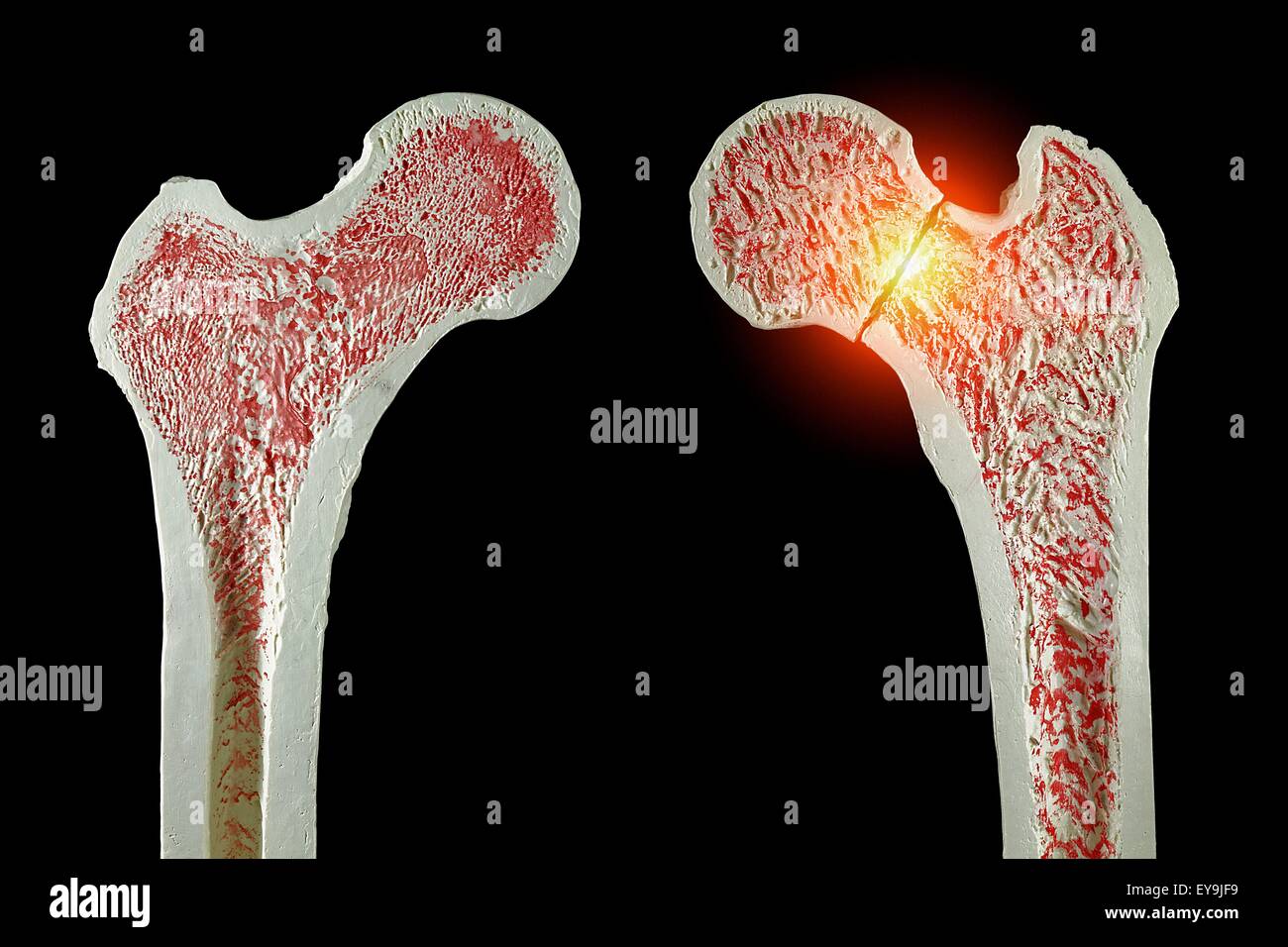 Sezioni trasversali attraverso modelli di un normale (sinistra) e femore fratturato (destra) del femore. Foto Stock