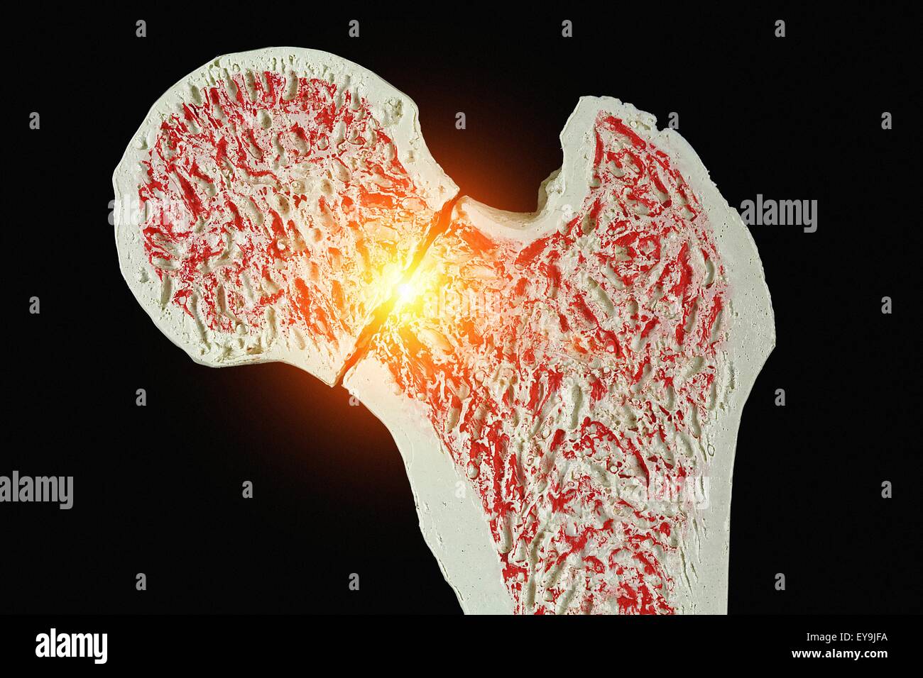 Sezione trasversale attraverso un modello di una frattura del collo del femore (femore). Foto Stock