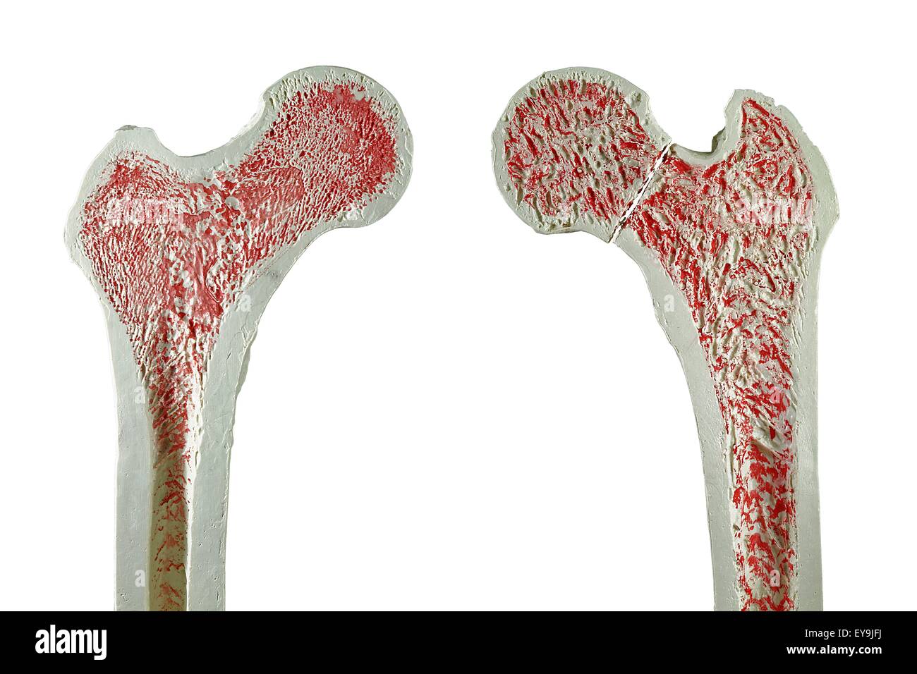 Sezioni trasversali attraverso modelli di un normale (sinistra) e femore fratturato (destra) del femore. Foto Stock