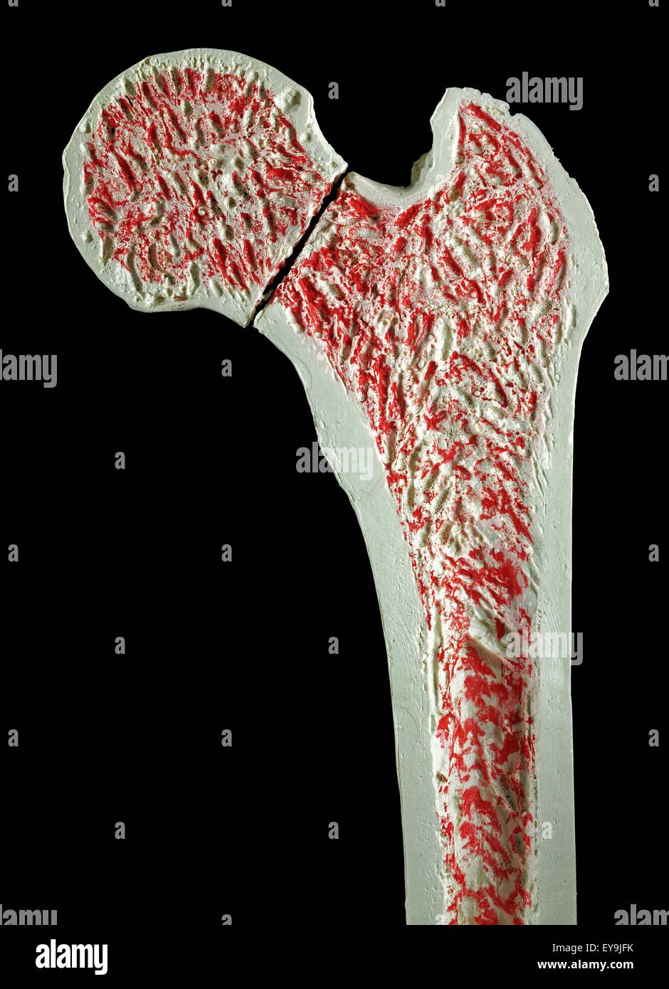 Sezione trasversale attraverso un modello di una frattura del collo del femore (femore). Foto Stock