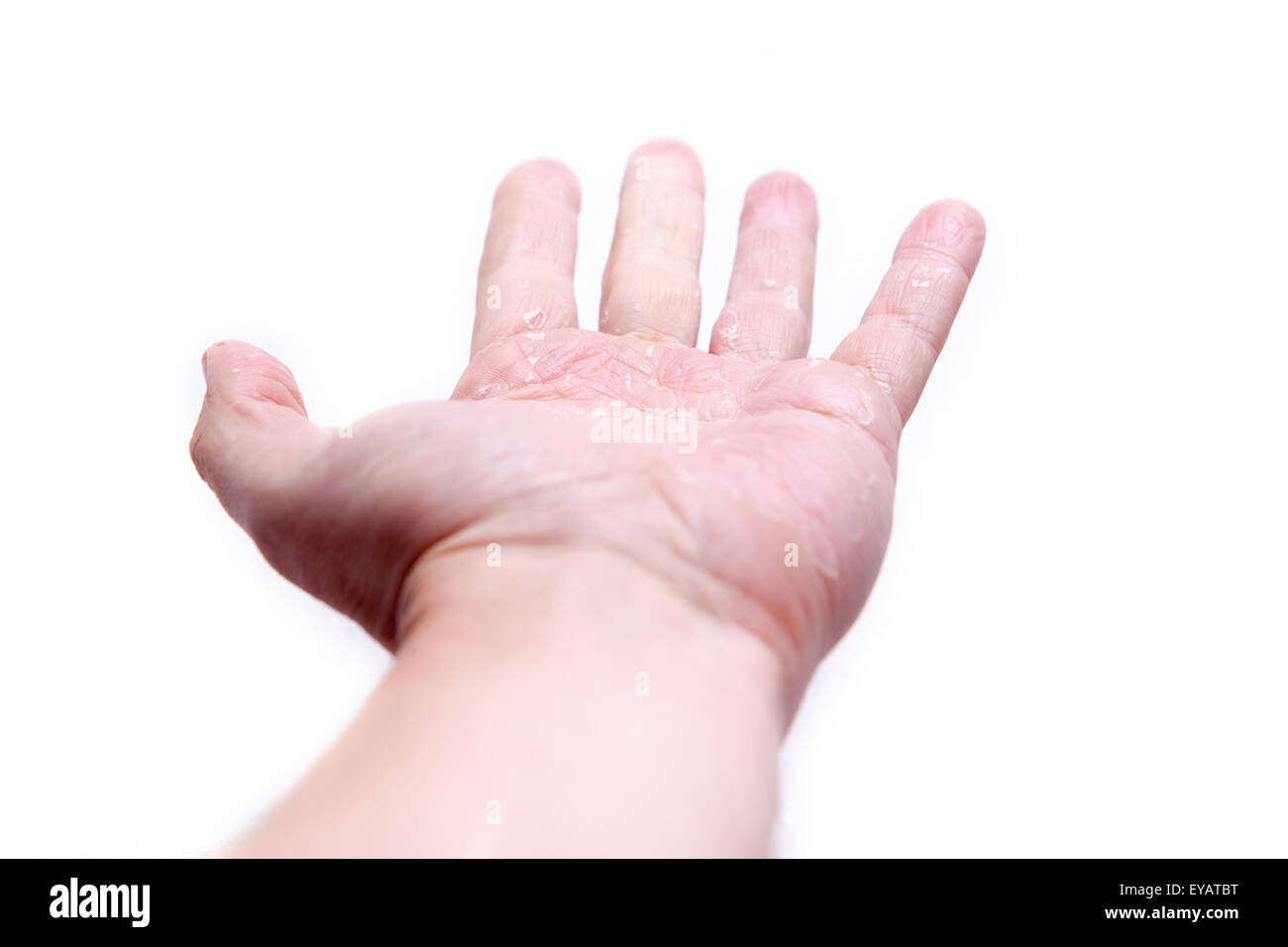Il problema con molte persone - eczema alle mani. Sfondo isolato Foto Stock