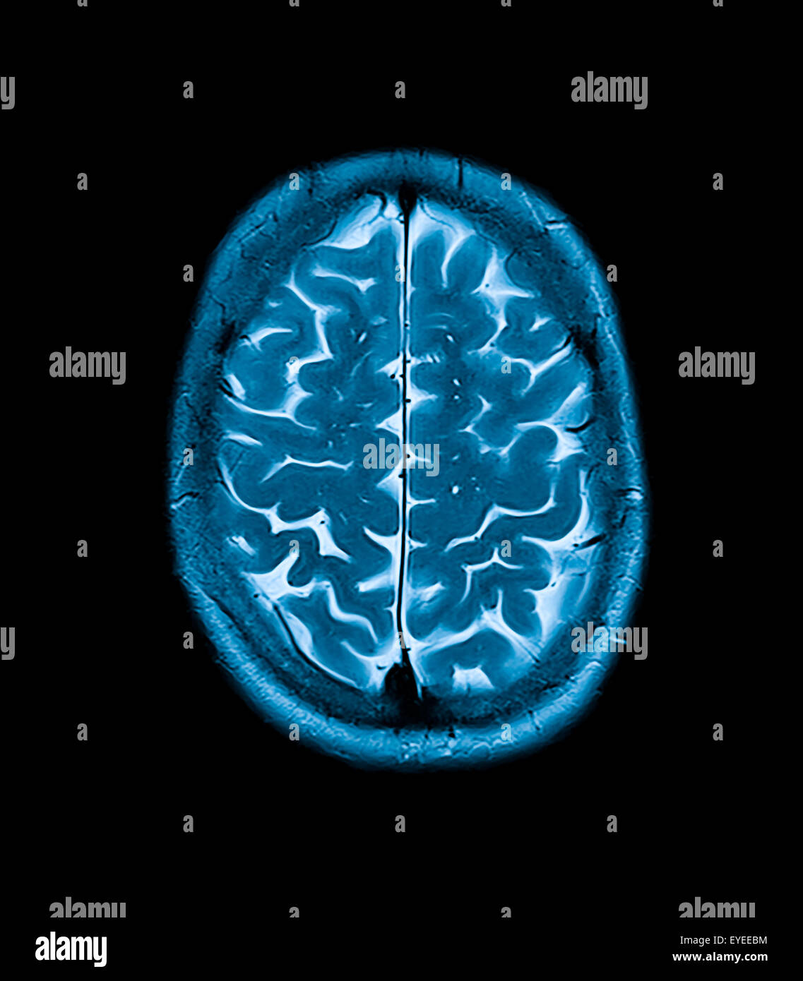 Testa di mri immagini a risonanza magnetica della scansione del capo Foto Stock