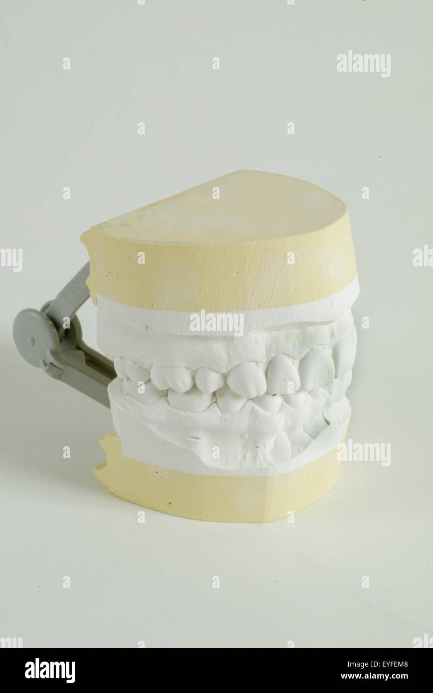 Un studio odontoiatrico cast di mascelle superiore ed inferiore. Il calco è un positivo di riproduzione dei denti e delle strutture circostanti per fini di studio e di pianificazione di trattamento creato versando per consentire un'impronta in gesso o pietra. Foto Stock
