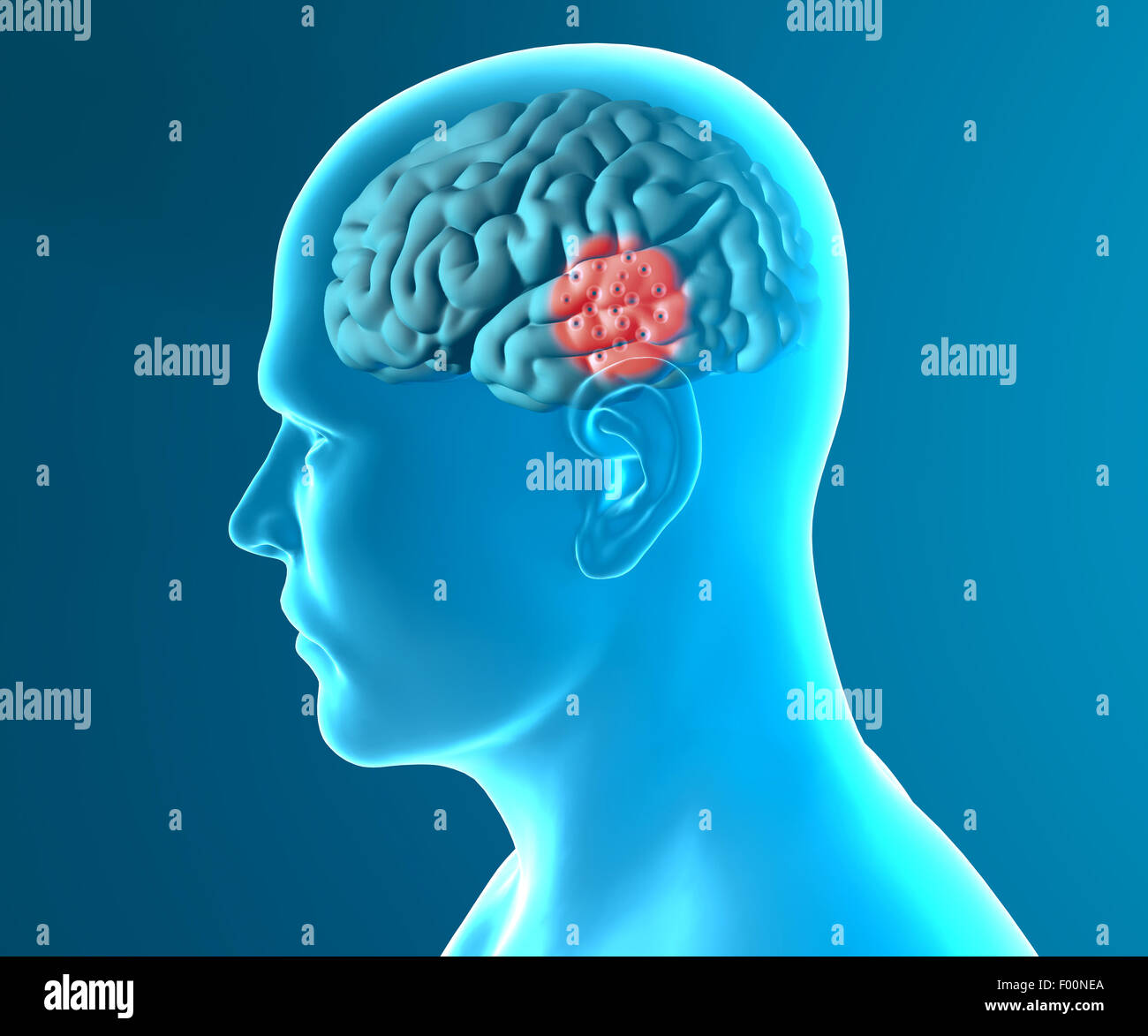 3d cervello malattie degenerative, morbo di Parkinson, morbo di Alzheimer Foto Stock