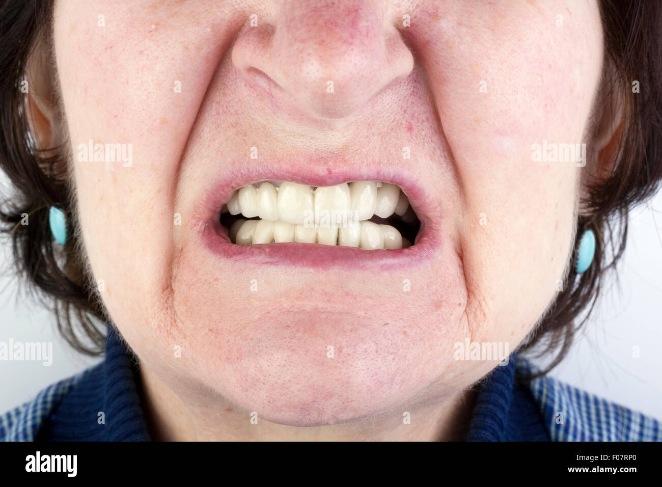 La donna anziana con nuove protesi in ceramica. Nella foto di difetti della pelle chiara visualizzazione - un tempo, birthmarks, capelli e ascessi . Foto Stock