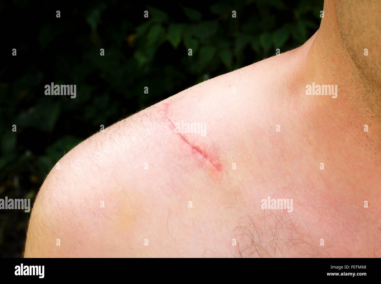 Primo piano della cicatrice chirurgica sulla spalla di un uomo in seguito oppurese il funzionamento per riparare la rottura di una clavicola Foto Stock