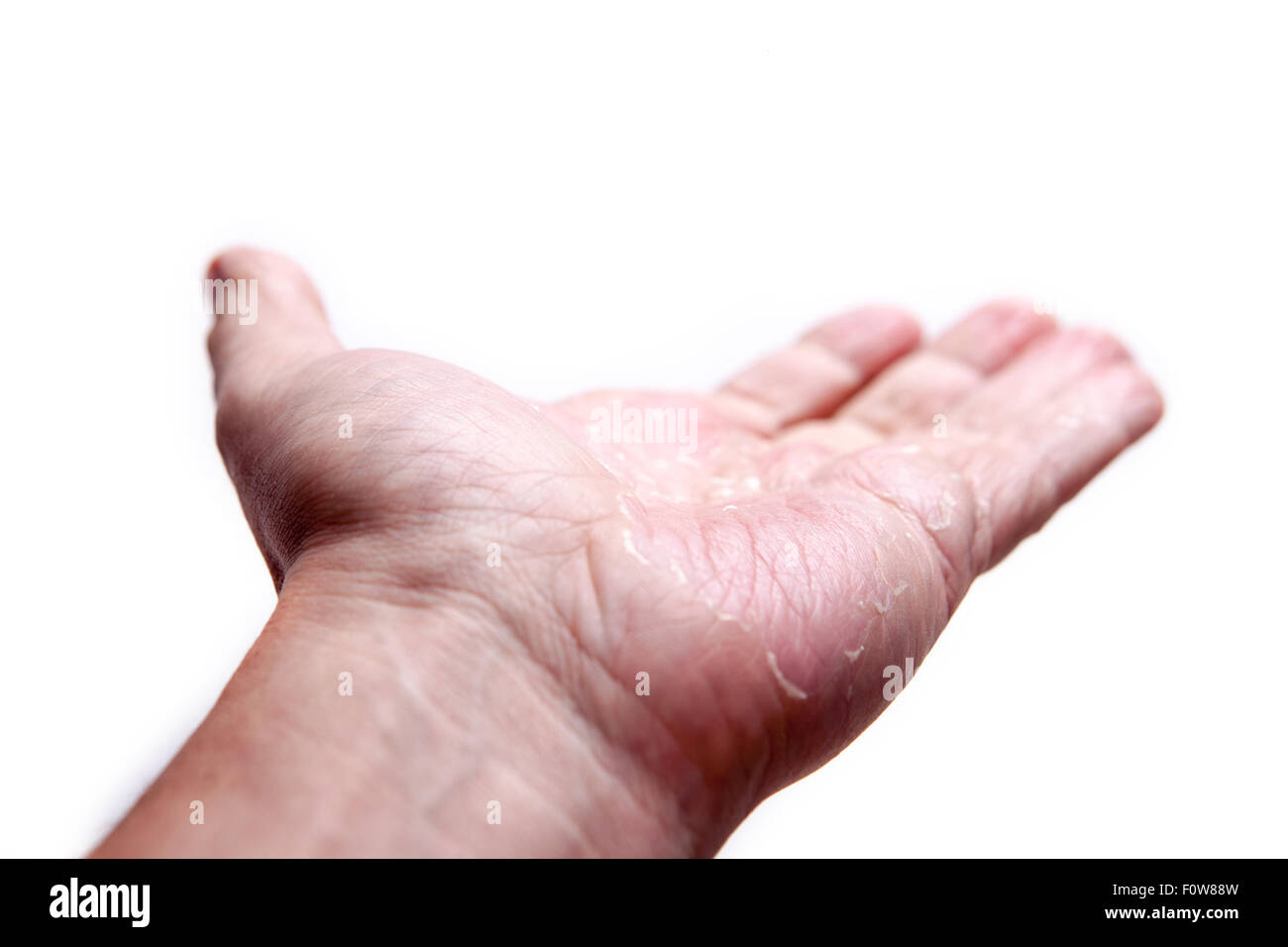 Le palme di sesso maschile con eczema isolati su sfondo bianco Foto Stock