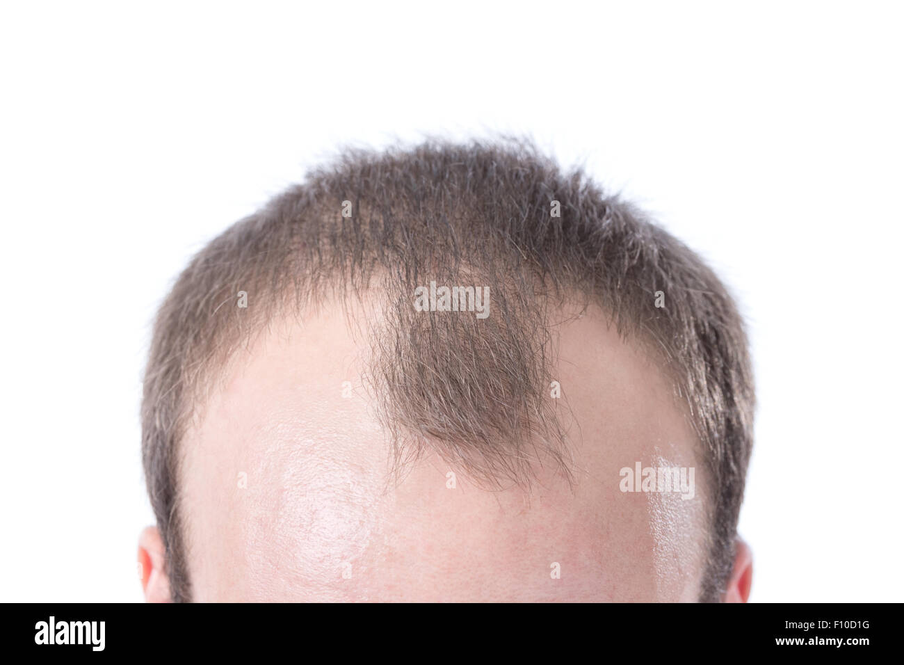 Un maschio bianco con capelli castani's receding hairline su uno sfondo bianco. Foto Stock