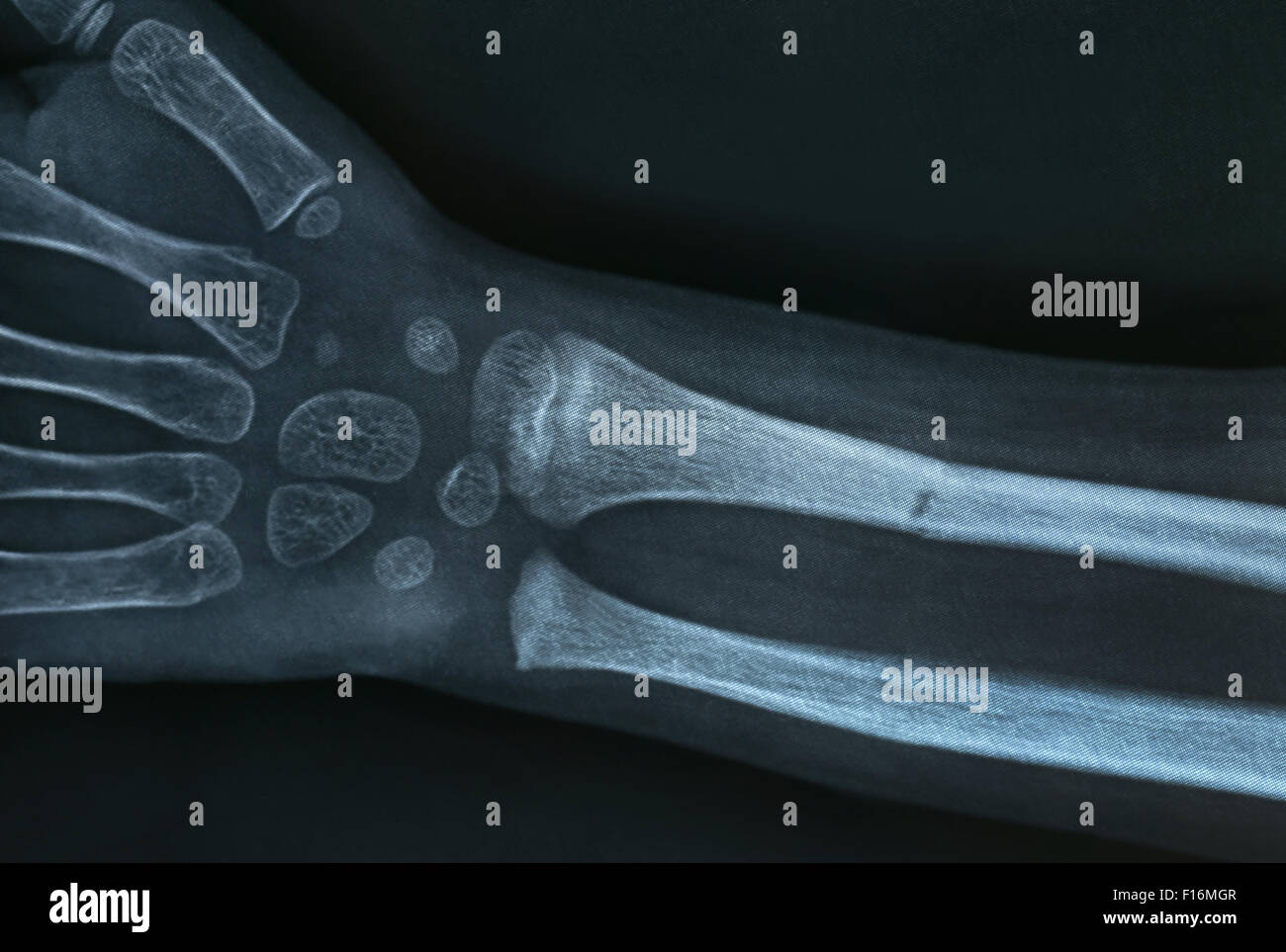 In prossimità di una mano brokan Xray Foto Stock