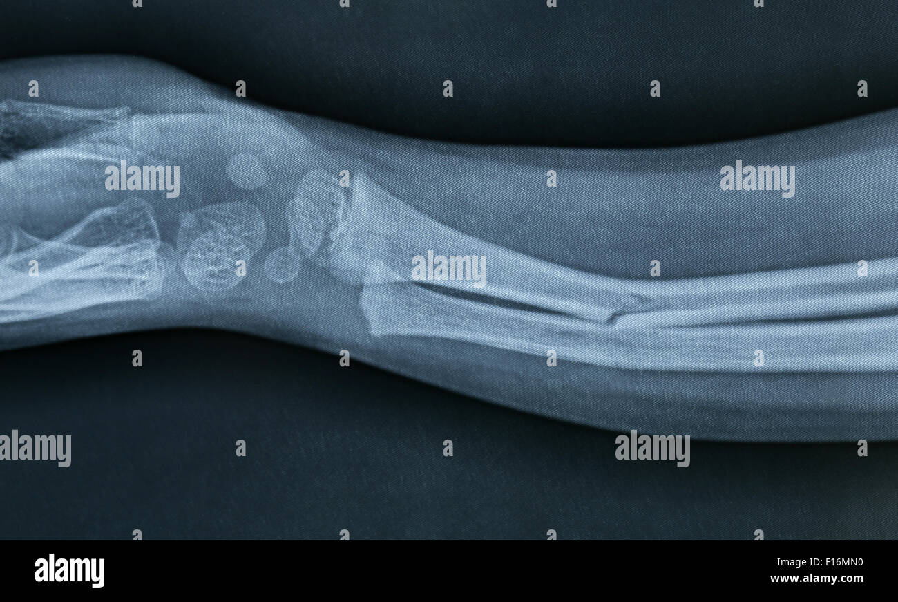 In prossimità di una mano brokan Xray Foto Stock