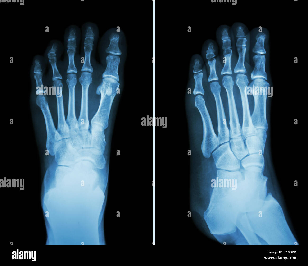 Film x-ray entrambi i piedi ( 2 posizione : vista anteriore e la vista laterale ) Foto Stock