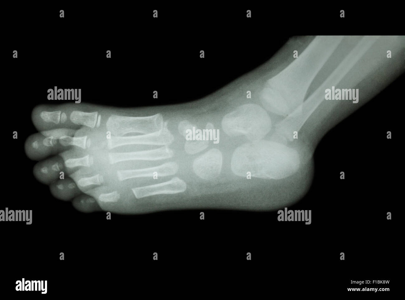 La pellicola a raggi x del bambino 's piedi ( vista laterale ) ( ) laterale Foto Stock