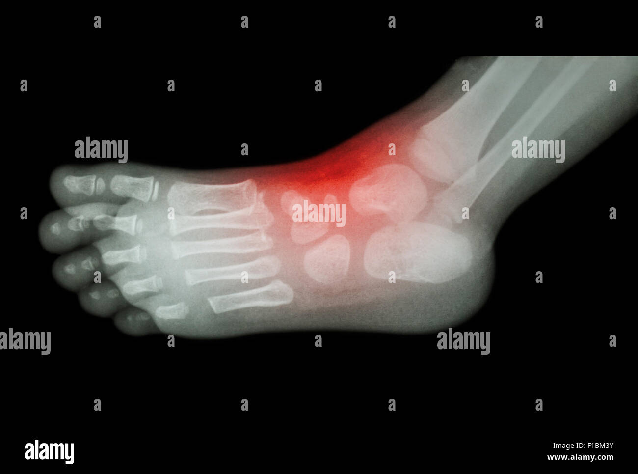 Artrite e lesioni alla caviglia : film x-ray del bambino 's piedi ( vista laterale ) ( ) laterale Foto Stock