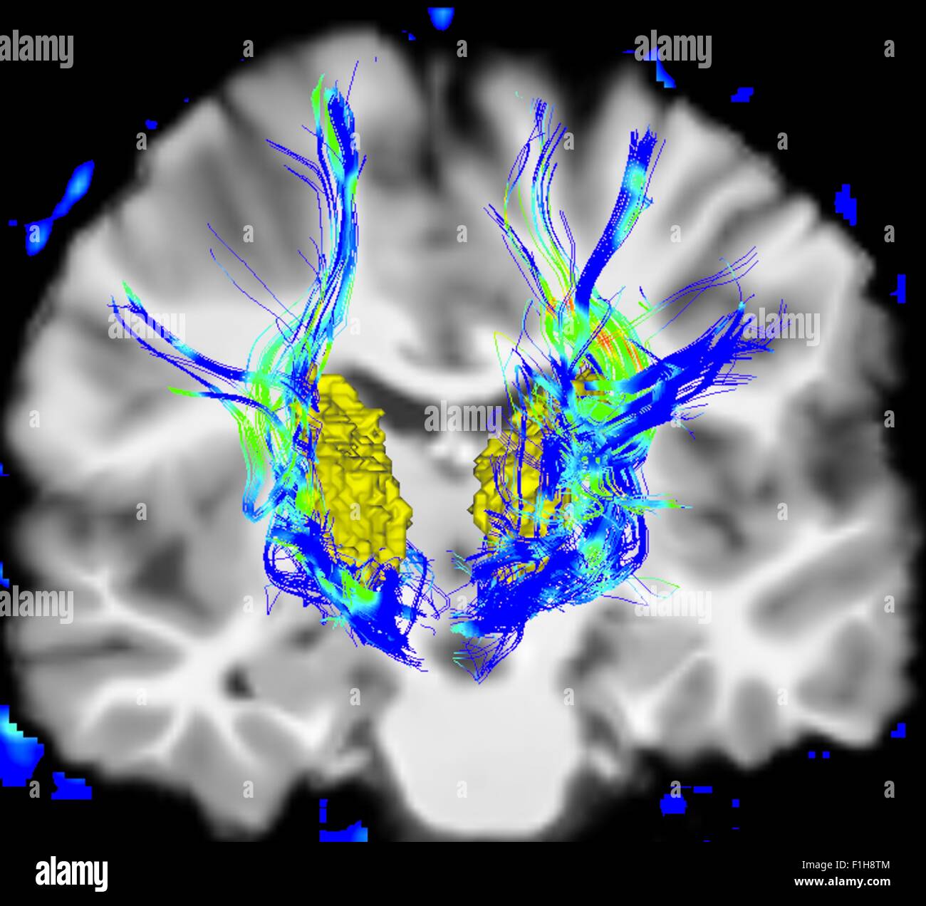 Vista coronale del cervello umano il morbo di Parkinson. Superficie gialla è il talamo blu/aree verdi evidenziare fibre sistema motore Foto Stock