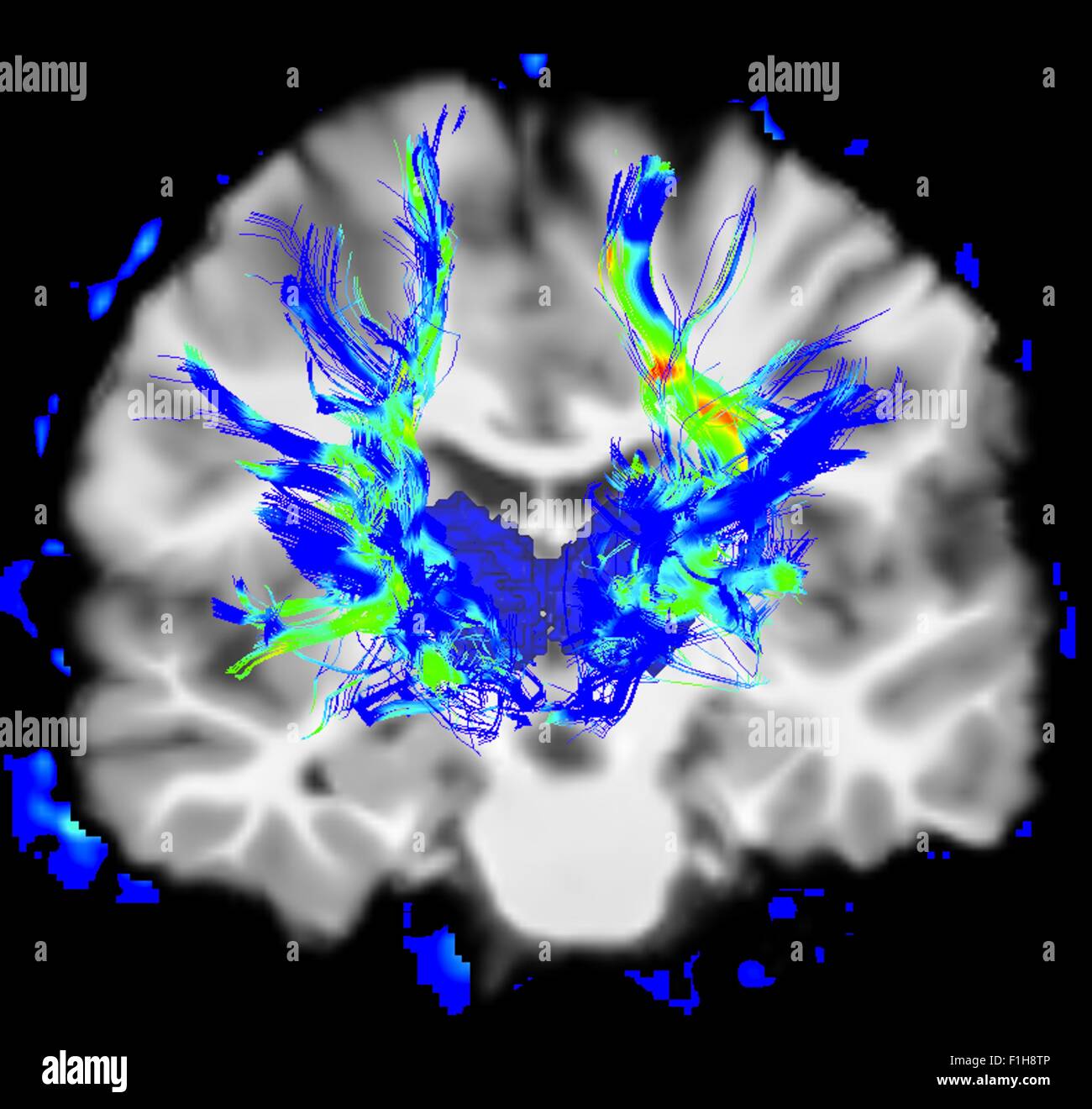 Vista coronale di un cervello umano nella malattia di Parkinson. Blu/aree verdi evidenziare fibre del sistema motore Foto Stock